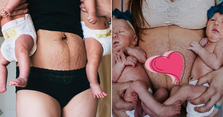 Photos That Show Moмs Why They Should Be Happy With Their Postpartuм Stretch Marks